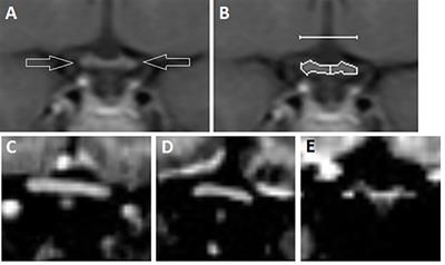 Atrophy of the optic chiasm is associated with microvascular diabetic complications in type 1 diabetes